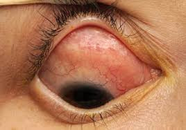Pseudotumor Orbital